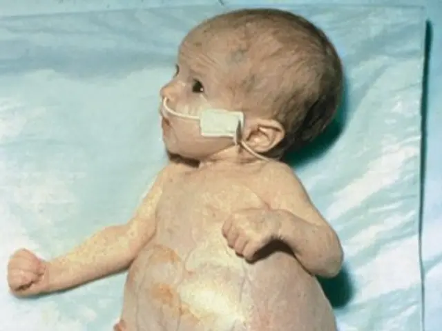 The image shows a premature baby laying on top of a blue blanket, with an oxygen tube in its mouth.